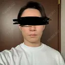 糸リフト / 脂肪吸引（顔） / ジョールファット除去 アリエル美容クリニック 郡山院 DAY 6 サムネイル用