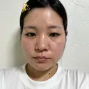 糸リフト / バッカルファット除去 / 脂肪吸引（顔） / ボトックス（口角） / ボトックス（首） アリエル美容クリニック 水戸院 DAY 21 サムネイル用