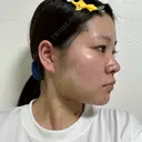 糸リフト / バッカルファット除去 / 脂肪吸引（顔） / ボトックス（口角） / ボトックス（首） アリエル美容クリニック 水戸院 DAY 21 サムネイル用