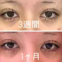 二重埋没 共立美容外科 立川院 DAY 34 サムネイル用