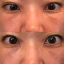 下まぶたたるみ取り セオリークリニック DAY 14 サムネイル用