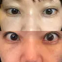 下まぶたたるみ取り セオリークリニック AFTER サムネイル用