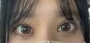 二重埋没 アリエル美容クリニック 郡山院 DAY 27 サムネイル用