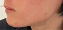 ボトックス（エラ・小顔） Tokyo Tensei Clinic 大阪梅田院 DAY 15 サムネイル用
