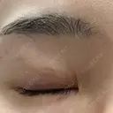 タレ目形成・グラマラスライン（埋没） Olino美容外科・美容皮膚科 DAY 9 サムネイル用