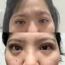 二重埋没 HAAB×DREAM BEAUTY CLINIC 大阪梅田院 AFTER サムネイル用