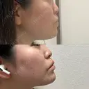 二重埋没 HAAB×DREAM BEAUTY CLINIC 大阪梅田院 DAY 4 サムネイル用