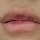 ヒアルロン酸注入（涙袋） / ヒアルロン酸注入（鼻） / 肌ヒアルロン酸注入（たるみ・シワ改善） / ヒアルロン酸注入（あご） / ヒアルロン酸注入（唇） / ヒアルロン酸注入（額） / ヒアルロン酸注入（頬） / ヒアルロン酸注入（目の下） / ヒアルロン酸注入（こめかみ） / ヒアルロン酸注入（鼻翼基部） 名古屋美容外科 AFTER サムネイル用