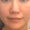 肌育注射（ジュベルックなど） 城本クリニック 立川院 DAY 0 サムネイル用