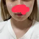 糸リフト / 脂肪吸引（顔） / ボトックス（エラ・小顔） PRISM Beauty Clinic 町田院 DAY 22 サムネイル用
