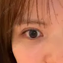 二重埋没 水の森美容クリニック 横浜院 DAY 4 サムネイル用