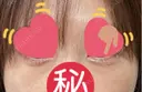 ヒアルロン酸注入（涙袋） PRO CLINIC プロクリニック 銀座院 DAY 17 サムネイル用