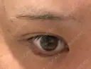 自然癒着法 / ヒアルロン酸注入（涙袋） CLINIC W DAY 5 サムネイル用