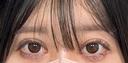二重埋没 アリエル美容クリニック 郡山院 AFTER サムネイル用