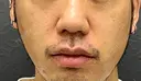 小鼻縮小（切開） 渋谷の森クリニック AFTER サムネイル用