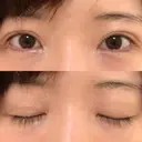 二重切開 / 目元修正 ルネッサンス美容外科医院 神戸院 DAY 189 サムネイル用