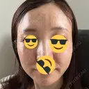 水光注射（ハリ・美肌） Chloe Cheongdam Clinic （クロエチョンダムクリニック） DAY 0 サムネイル用