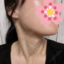 ルメッカ / インモード Moon Beauty Clinic DAY 3 サムネイル用