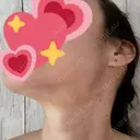 ルメッカ / インモード Moon Beauty Clinic DAY 4 サムネイル用