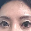 眉下切開 MOMO CLINIC AFTER サムネイル用