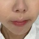 ヒアルロン酸注入（涙袋） / ヒアルロン酸注入（鼻翼基部） ルラ美容クリニック 渋谷本院 DAY 1 サムネイル用