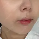 ヒアルロン酸注入（涙袋） / ヒアルロン酸注入（鼻翼基部） ルラ美容クリニック 渋谷本院 DAY 1 サムネイル用