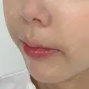 ヒアルロン酸注入（涙袋） / ヒアルロン酸注入（鼻翼基部） ルラ美容クリニック 渋谷本院 DAY 1 サムネイル用