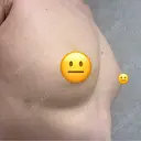脂肪吸引（脚） / 脂肪吸引（お腹） / 豊胸（脂肪注入） Lipo Clinic omotesando DAY 30 サムネイル用