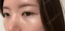 水光注射（ハリ・美肌） GLAMRULE CLINIC (グラムルール クリニック) 銀座院 AFTER サムネイル用