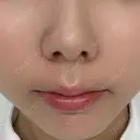 ヒアルロン酸注入（涙袋） / ヒアルロン酸注入（鼻翼基部） ルラ美容クリニック 渋谷本院 DAY 2 サムネイル用