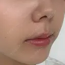 ヒアルロン酸注入（涙袋） / ヒアルロン酸注入（鼻翼基部） ルラ美容クリニック 渋谷本院 DAY 2 サムネイル用