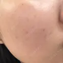 ピコレーザートーニング（美白・肝斑） DAILY SKIN CLINIC 福岡院 AFTER サムネイル用