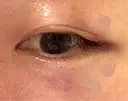 肌ヒアルロン酸注入（たるみ・シワ改善） / ヒアルロン酸注入（あご） / ヒアルロン酸注入（額） / ヒアルロン酸注入（頬） / ヒアルロン酸注入（こめかみ） PRISM Beauty Clinic 町田院 DAY 3 サムネイル用