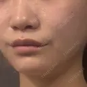 糸リフト / 脂肪吸引（顔） / ボトックス（エラ・小顔） First Clinic AFTER サムネイル用