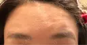 ボトックス（眉間） / ボトックス（額） HAAB×DREAM BEAUTY CLINIC 大阪梅田院 AFTER サムネイル用