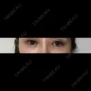 クマ治療 / 目尻切開 / タレ目形成・グラマラスライン（切開） / 脂肪注入（目の下） 藤・ナチュレ美容クリニック 銀座院 AFTER サムネイル用