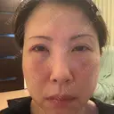 クマ治療 NARU Beauty Clinic 【ナルクリ】 DAY 1 サムネイル用