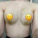 脂肪吸引（脚） / 豊胸（脂肪注入） Lipo Clinic omotesando DAY 4 サムネイル用