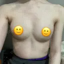 脂肪吸引（脚） / 豊胸（脂肪注入） Lipo Clinic omotesando DAY 16 サムネイル用