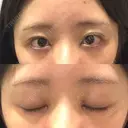目頭切開 聖心美容クリニック 福岡院 DAY 5 サムネイル用
