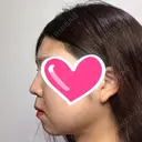 隆鼻術 / 鼻尖形成（切開） / 鼻中隔延長（切開） / 小鼻縮小（切開） ザ・プラス美容外科 DAY 246 サムネイル用
