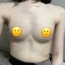 脂肪吸引（脚） / 豊胸（脂肪注入） Lipo Clinic omotesando DAY 64 サムネイル用
