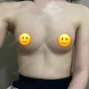 脂肪吸引（脚） / 豊胸（脂肪注入） Lipo Clinic omotesando DAY 91 サムネイル用