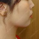 糸リフト / 脂肪吸引（顔） / あご下筋肉縛り LUHO（ルホ）美容外科 DAY 185 サムネイル用
