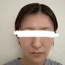 脂肪注入（額） / ボトックス（あご） / ヒアルロン酸注入（唇） / 脂肪注入（輪郭） アリエル美容クリニック 大宮院 AFTER サムネイル用