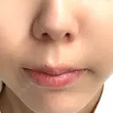 ヒアルロン酸注入（涙袋） / ヒアルロン酸注入（鼻翼基部） ルラ美容クリニック 渋谷本院 AFTER サムネイル用