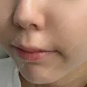 ヒアルロン酸注入（涙袋） / ヒアルロン酸注入（鼻翼基部） ルラ美容クリニック 渋谷本院 DAY 8 サムネイル用