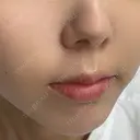 ヒアルロン酸注入（涙袋） / ヒアルロン酸注入（鼻翼基部） ルラ美容クリニック 渋谷本院 DAY 8 サムネイル用