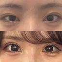 目頭切開 / タレ目形成・グラマラスライン（埋没） ネビュラクリニック 東京錦糸町院 AFTER サムネイル用