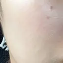 肌育注射（ジュベルックなど） / イオン導入 / 光治療（フォトフェイシャルなど） / ルメッカ Belle Via Clinic AFTER サムネイル用